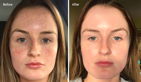 tca peel reviews|TCA Peels, Explained: The Benefits, Cost, and Results .
